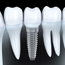 A diagram of a dental implant next to natural teeth