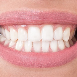Closeup of perfectly straight teeth with Invisalign