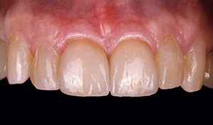 Repaired and brilliant white teeth - patient 1