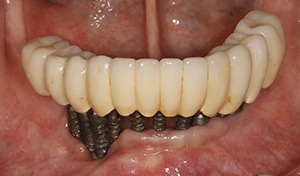 Failed implant supported denture - patient 2